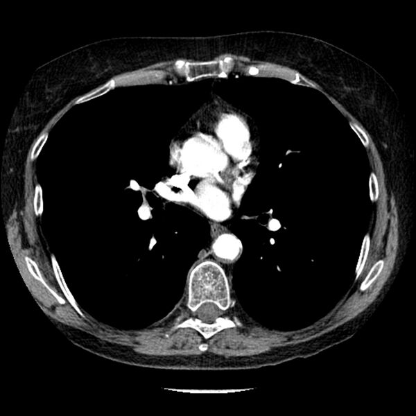 File:Adenocarcinoma of the lung (Radiopaedia 41015-43755 Axial C+ portal venous phase 64).jpg