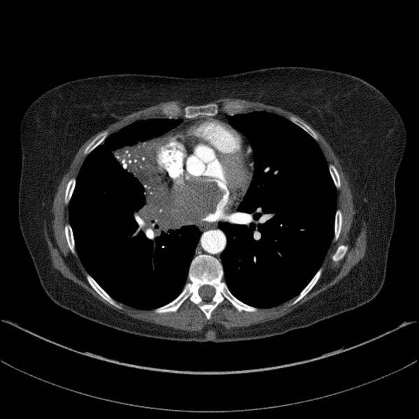 File:Adenocarcinoma of the lung (Radiopaedia 44205-47803 Axial C+ portal venous phase 50).jpg