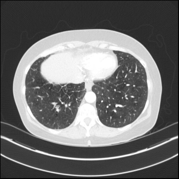 File:Adenocarcinoma of the lung (Radiopaedia 44205-47803 Axial lung window 70).jpg