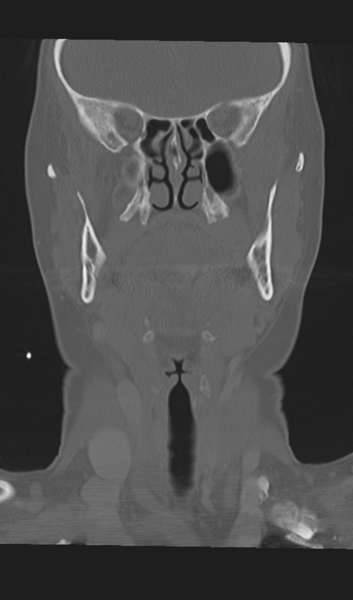 File:Adenoid cystic tumor of palate (Radiopaedia 46980-51518 Coronal bone window 28).png