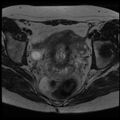 Adenoma malignum of the cervix (Radiopaedia 24460-24765 C 11).jpg