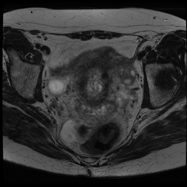 File:Adenoma malignum of the cervix (Radiopaedia 24460-24765 C 11).jpg
