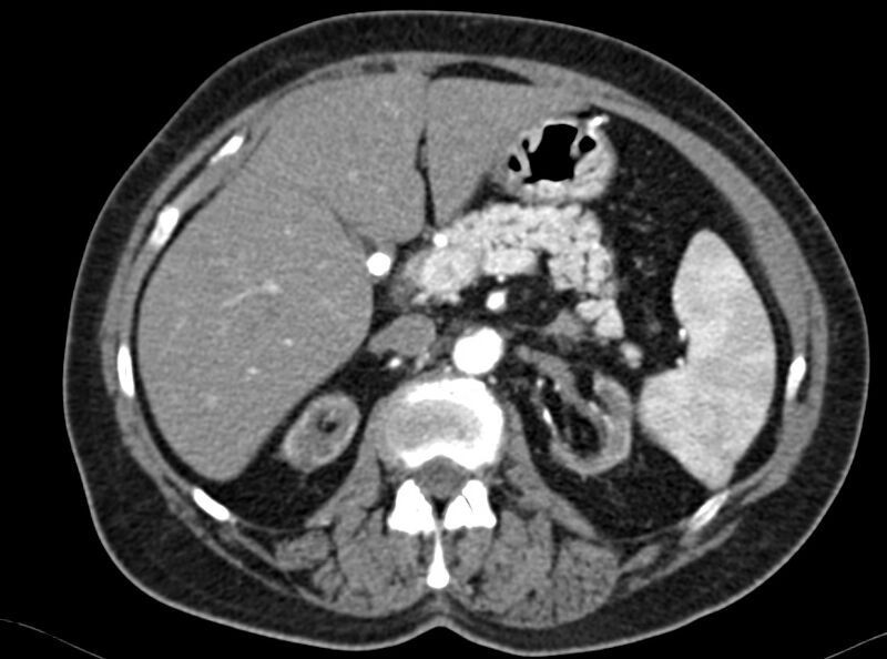 File:Adenomyomatosis of the gallbladder (Radiopaedia 12142-12483 Axial C+ arterial phase 6).jpg