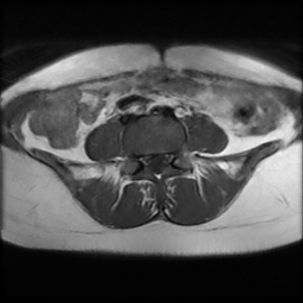 File:Adenomyosis within a septate uterus (Radiopaedia 69963-79981 Axial T1 1).jpg