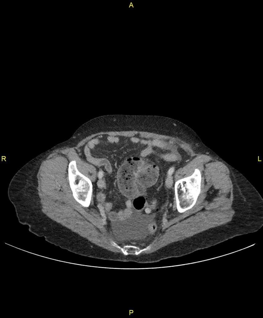 Adhesional small bowel obstruction (Radiopaedia 85402-101024 Axial C+ portal venous phase 246).jpg