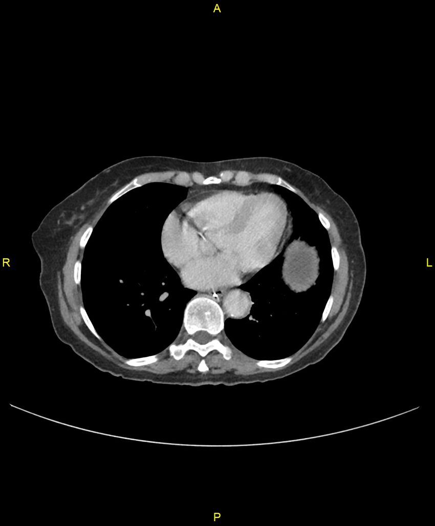 Adhesional small bowel obstruction (Radiopaedia 85402-101024 Axial C+ portal venous phase 3).jpg