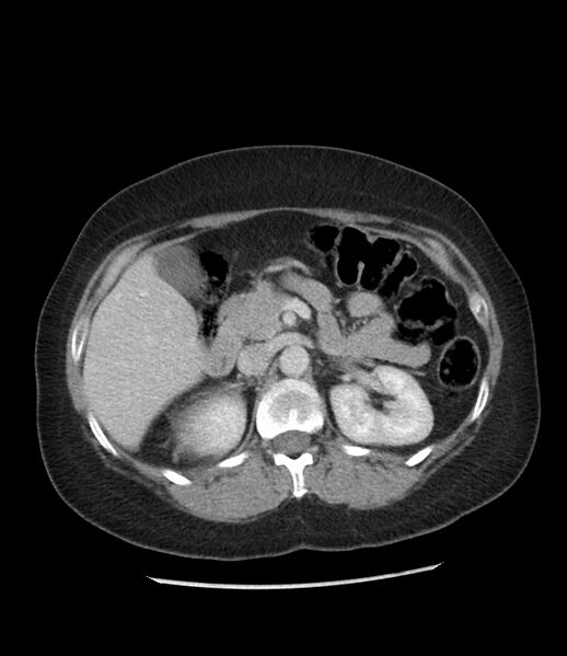 File:Adrenal cortical carcinoma with IVC invasion and thrombosis (Radiopaedia 34307-35597 Axial C+ portal venous phase 31).jpg