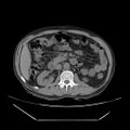 Adrenal myelolipoma (Radiopaedia 41843-44834 Axial non-contrast 33).jpg