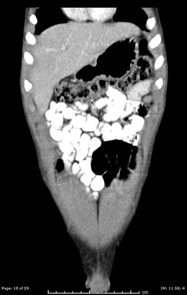 File:Agenesis of the gallbladder (Radiopaedia 55454-61905 A 10).jpg