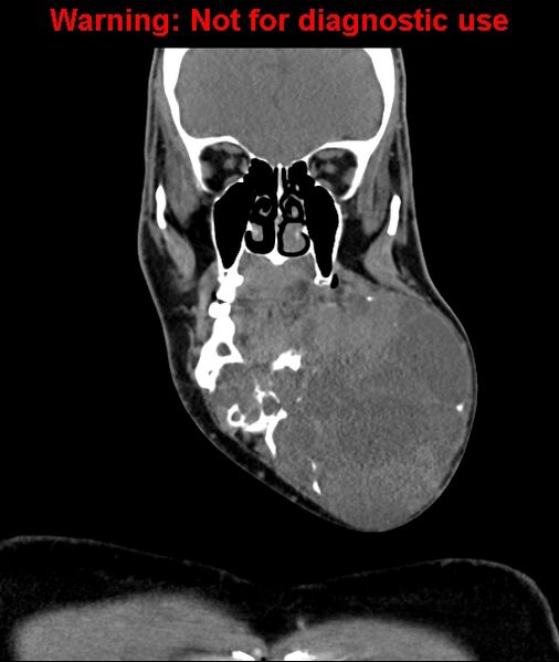 File:Ameloblastoma (Radiopaedia 33126-34164 D 26).jpg