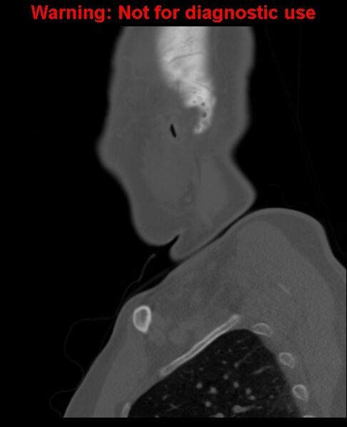 File:Ameloblastoma (Radiopaedia 33126-34164 Sagittal bone window 63).jpg