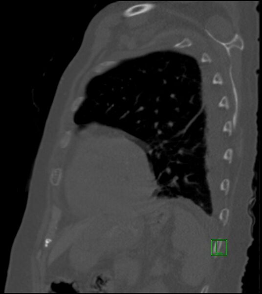 File:Amiodarone deposition in the liver (Radiopaedia 77587-89780 Sagittal bone window 28).jpg