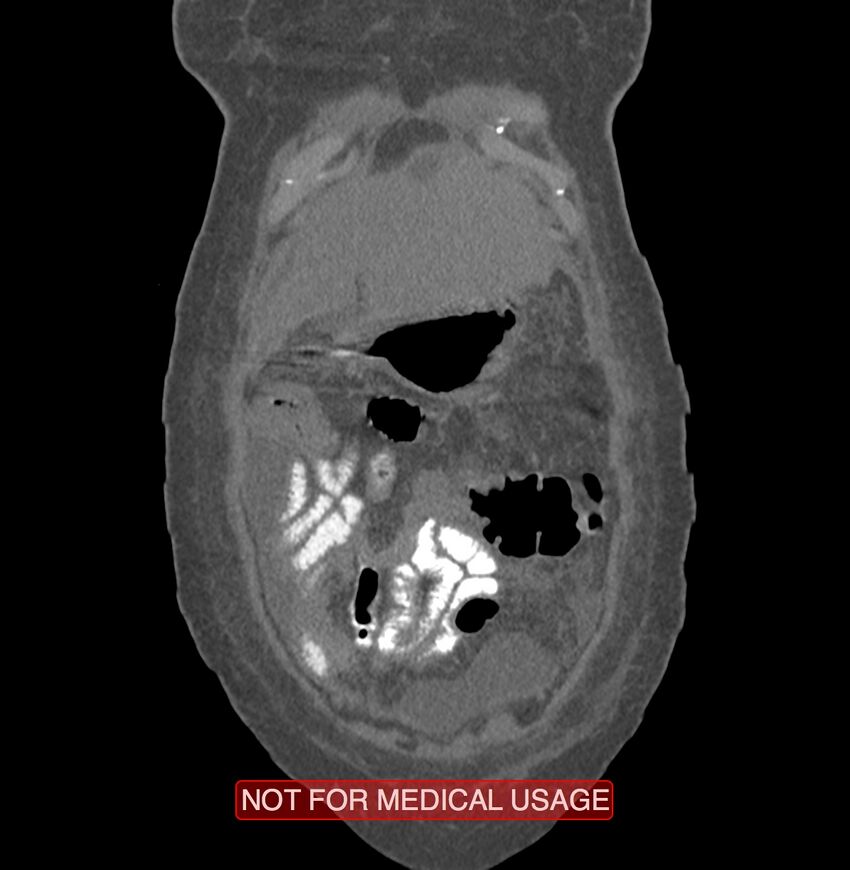 Amoebic enterocolitis with liver abscess (Radiopaedia 35100-36609 B 10).jpg