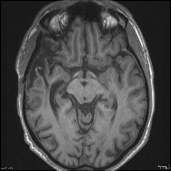 File:Anaplastic meningioma with recurrence (Radiopaedia 34452-35788 Axial T1 57).jpg