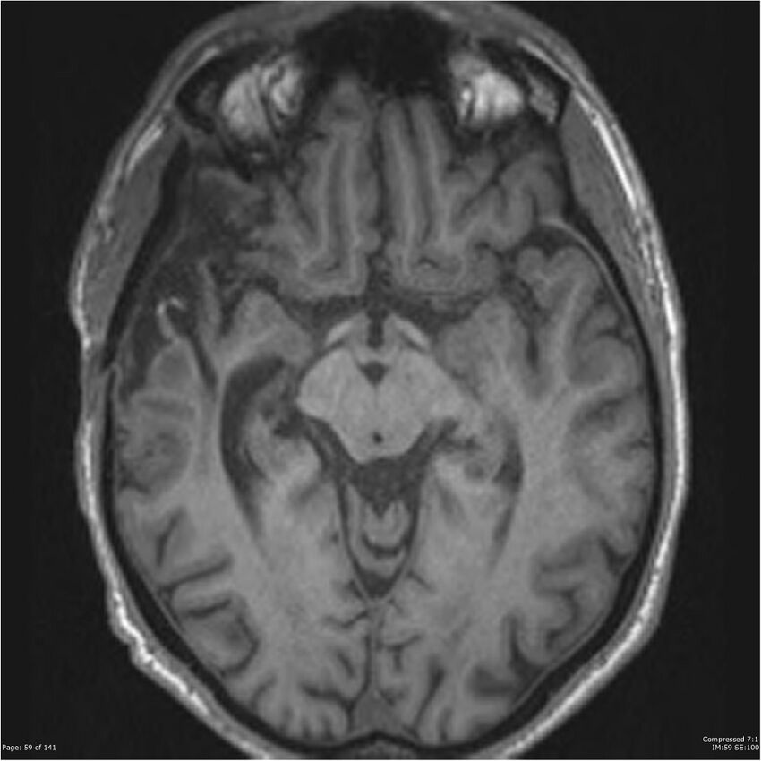 Anaplastic meningioma with recurrence (Radiopaedia 34452-35788 Axial T1 57).jpg