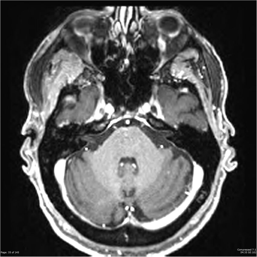 Anaplastic meningioma with recurrence (Radiopaedia 34452-35788 Axial T1 C+ 35).jpg