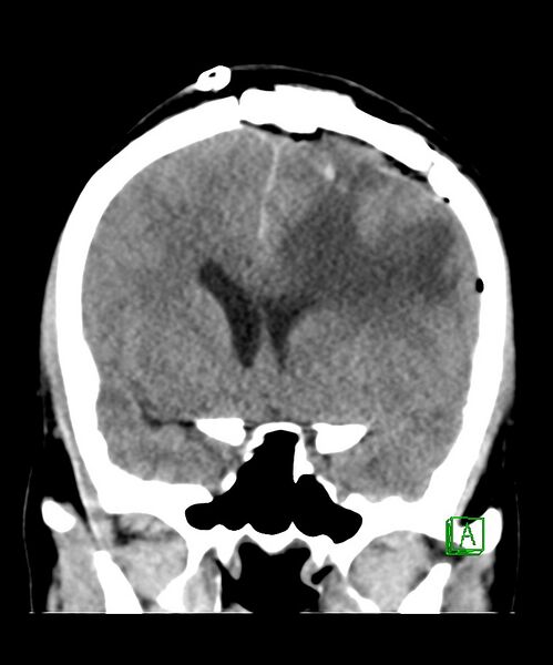 File:Angiomatous meningioma (Radiopaedia 79459-92578 Coronal non-contrast 16).jpg