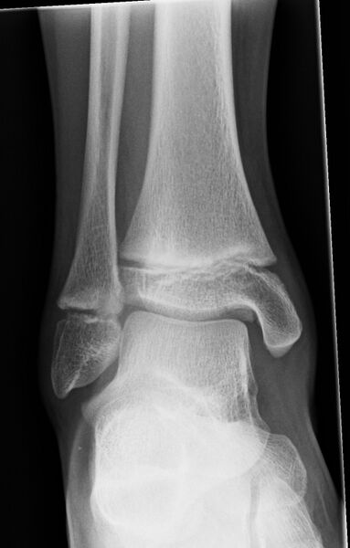File:Ankle joint effusion post-trauma (Radiopaedia 44180-47766 Frontal 1).jpg