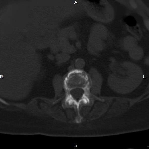 File:Ankylosing spondylitis (Radiopaedia 8748-9556 Axial bone window 25).jpg