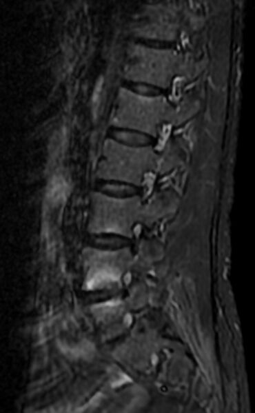 File:Ankylosing spondylitis - Andersson lesion (Radiopaedia 81878-95838 Sagittal STIR 4).jpg