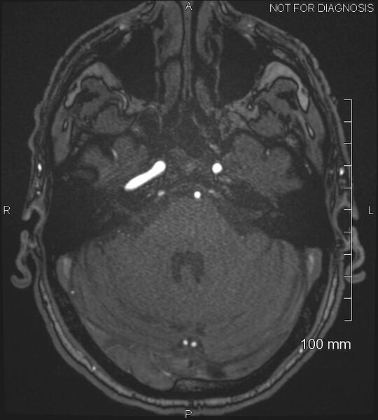 File:Anterior cerebral artery aneurysm (Radiopaedia 80683-94127 Axial MRA 56).jpg