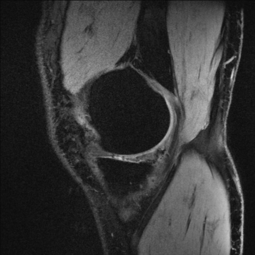 Anterior cruciate ligament mucoid degeneration (Radiopaedia 68400-77933 Sagittal 55).jpg