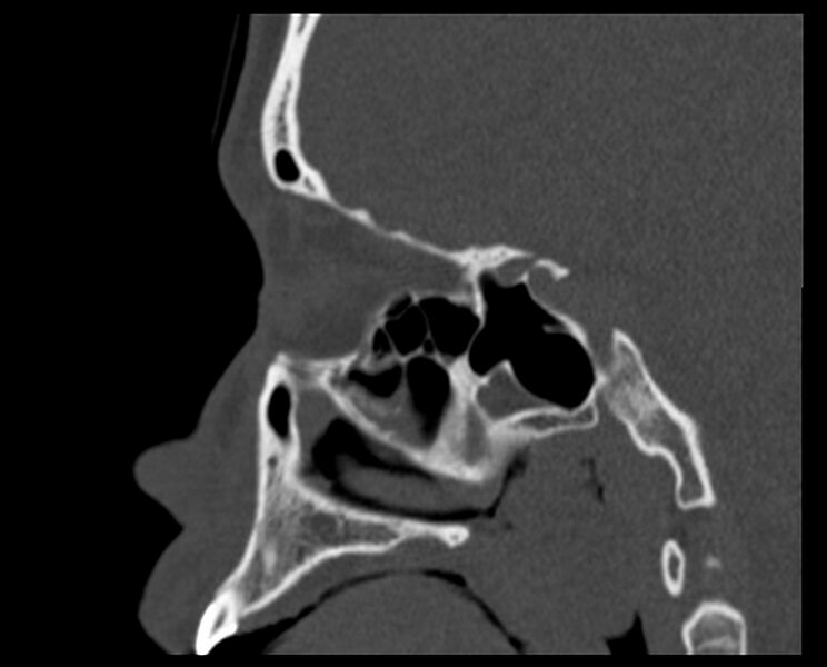 File:Antrochoanal polyp (Radiopaedia 21894-21868 Sagittal bone window 26).jpg