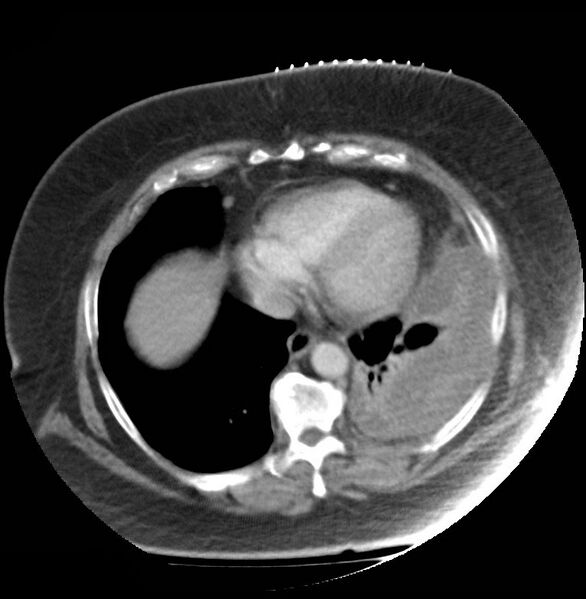 File:Aortic arch false aneurysm (Radiopaedia 14667-14588 A 17).jpg