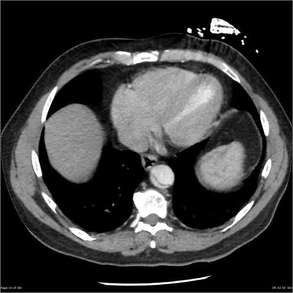 File:Aortic dissection- Stanford A (Radiopaedia 37759-39664 A 52).jpg