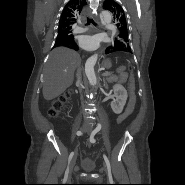 File:Aortic dissection (Radiopaedia 28802-29105 B 20).jpg