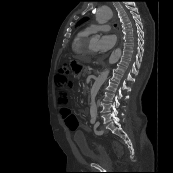 File:Aortic dissection (Radiopaedia 28802-29105 C 19).jpg