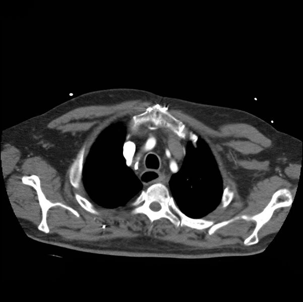 File:Aortic dissection with rupture into pericardium (Radiopaedia 12384-12647 A 11).jpg