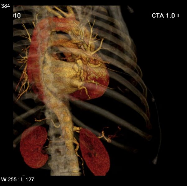 File:Aortic dissection with rupture into pericardium (Radiopaedia 12384-12647 C+ arterial phase 16).jpg