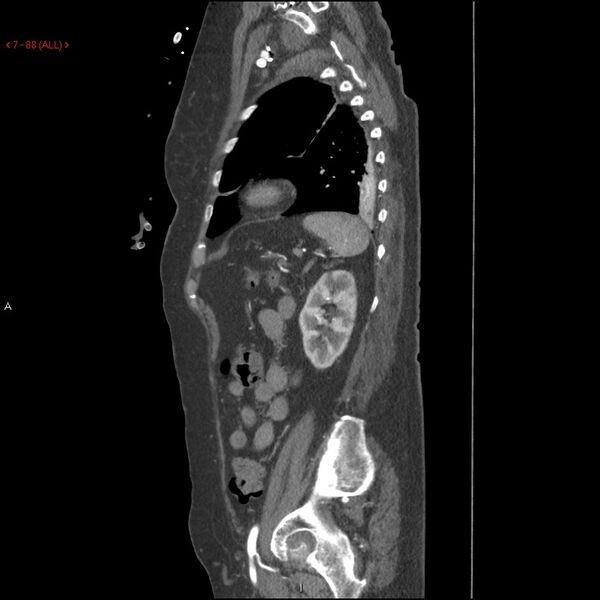 File:Aortic intramural hematoma (Radiopaedia 27746-28001 C 57).jpg
