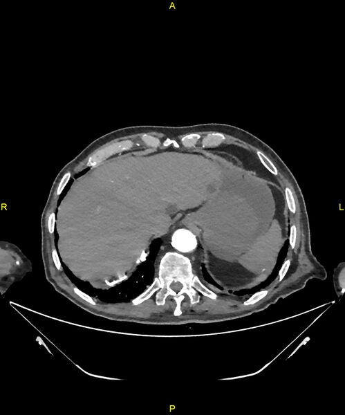 File:Aortoenteric fistula (Radiopaedia 84308-99603 B 36).jpg