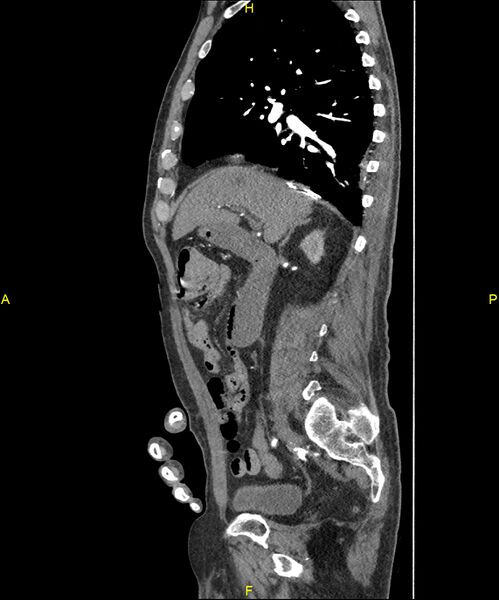 File:Aortoenteric fistula (Radiopaedia 84308-99603 C 132).jpg