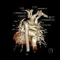 Aortopulmonary window, interrupted aortic arch and large PDA giving the descending aorta (Radiopaedia 35573-37077 3D 1).jpg