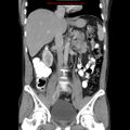Appendicitis and renal cell carcinoma (Radiopaedia 17063-16760 B 16).jpg