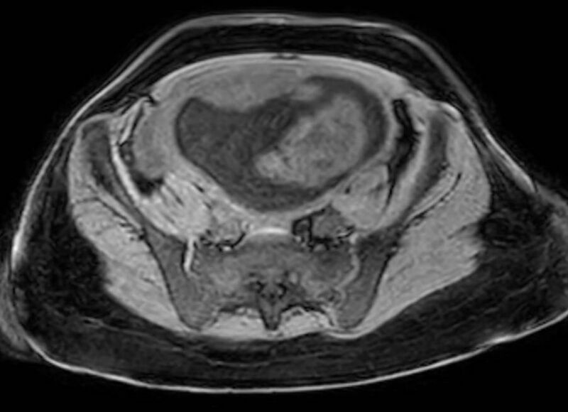 File:Appendicitis in gravida (MRI) (Radiopaedia 89433-106395 Axial DIXON 109).jpg