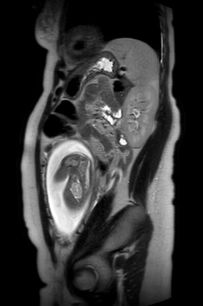 File:Appendicitis in gravida (MRI) (Radiopaedia 89433-106395 Sagittal T2 20).jpg