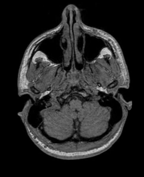 File:Arachnoid cyst- extremely large (Radiopaedia 68741-78451 Axial T1 13).jpg