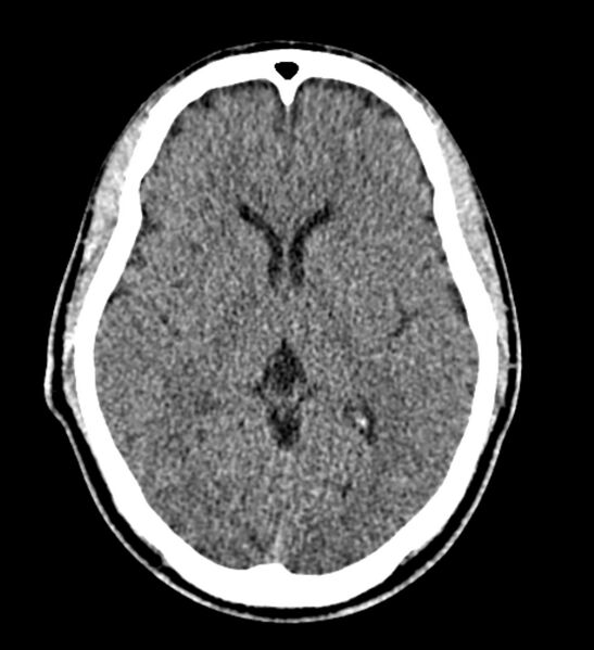 File:Arachnoid cyst of the ambient cistern (Radiopaedia 81301-94986 Axial non-contrast 37).jpg