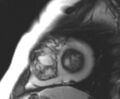Arrhythmogenic right ventricular cardiomyopathy (Radiopaedia 69431-79307 Short axis cine 27).jpg
