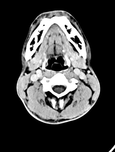 File:Arrow injury to the face (Radiopaedia 73267-84011 Axial C+ delayed 15).jpg