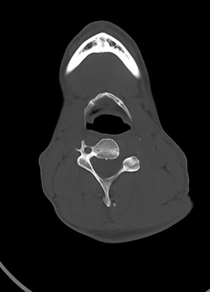 File:Arrow injury to the head (Radiopaedia 75266-86388 Axial bone window 11).jpg