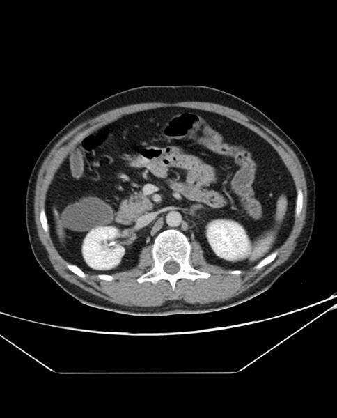 File:Arterial occlusive mesenteric ischemia (Radiopaedia 84641-100054 A 45).jpg