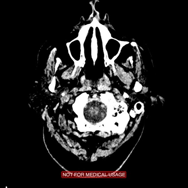 File:Artery of Percheron infarction (Radiopaedia 28679-28967 Axial non-contrast 6).jpg