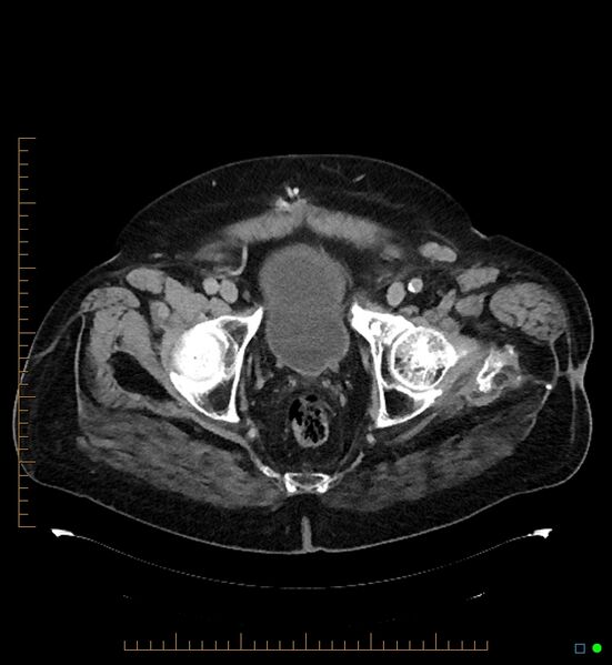 File:Artificial urethral sphincter (Radiopaedia 46937-51464 A 7).jpg