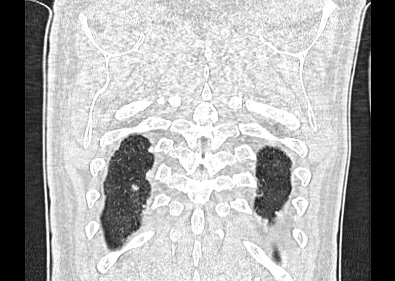 File:Asbestos pleural placques (Radiopaedia 57905-64872 Coronal lung window 272).jpg
