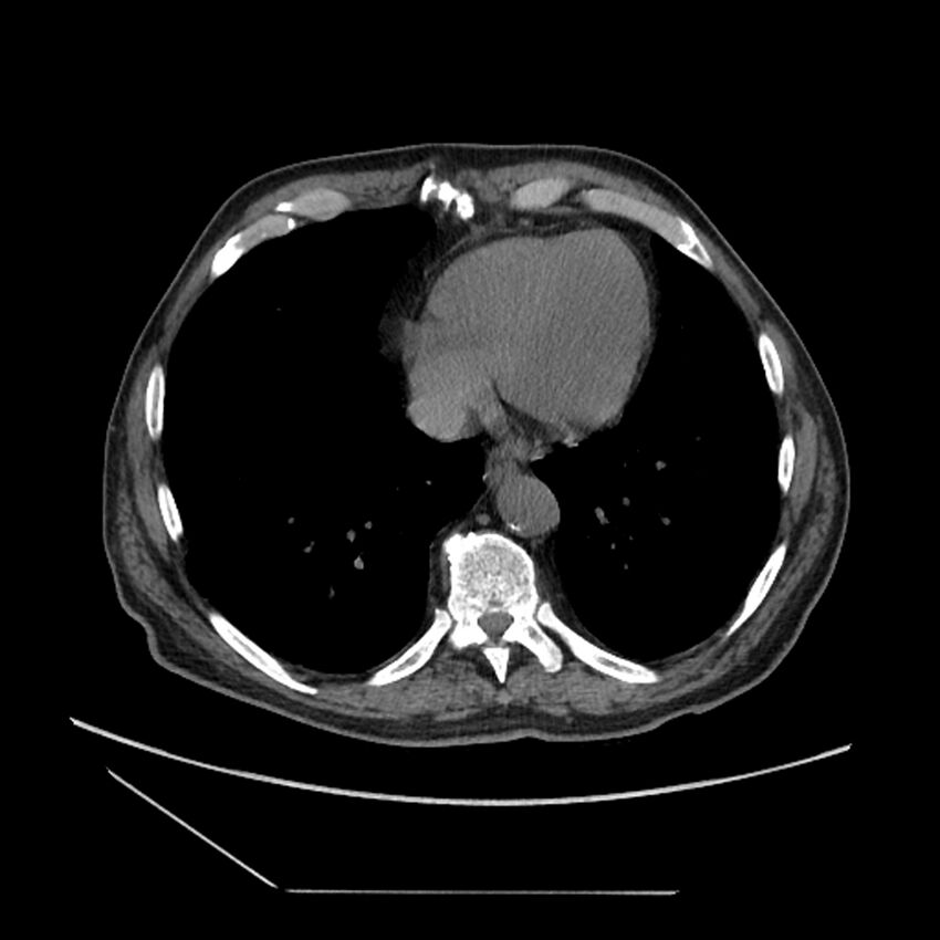 Asbestosis complicated by lung cancer (Radiopaedia 45834-50116 Axial non-contrast 48).jpg